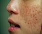Vzroki za motnje pigmentacije kože in metode njenega obnavljanja Kako zdraviti pigmentacijo kože