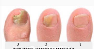 Что такое онихомикоз ногтей и как его лечить?