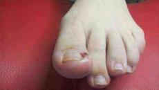 Нокътят на големия пръст на крака е възпален. След педикюр долната част на нокътя боли