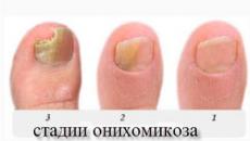 Šta je onikomikoza noktiju i kako je liječiti?