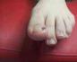 Нокътът на големия пръст на крака е възпален. След педикюр долната част на нокътя боли