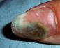 Najverjetnejši vzroki temne lise na nohtu velikega prsta