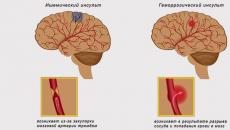 Zdravljenje ishemične možganske kapi Čas zdravljenja možganske kapi
