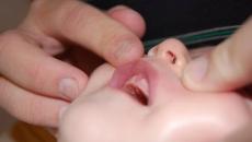 Drozd na jeziku bebe: liječenje i prevencija bolesti