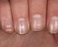 Почему появляются продольные и поперечные полосы на ногтях Черные полосы в ногтевой пластине