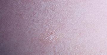 Защо възниква атрофия на кожата, видове, симптоми на атрофия